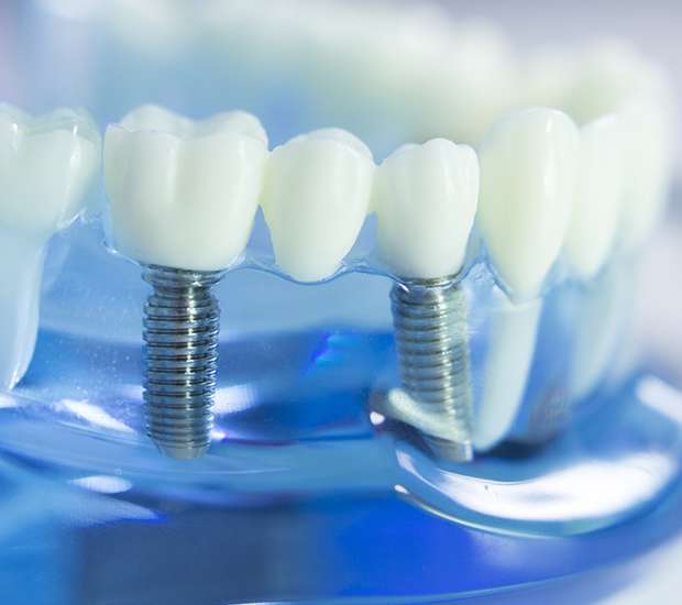 Redwood City Dental Implants
