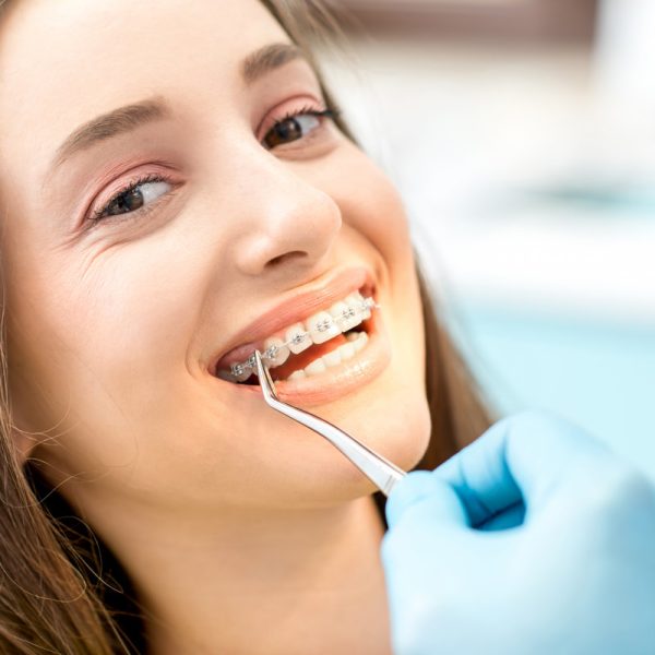 Putting dental braces to the woman's teeth at the dental office