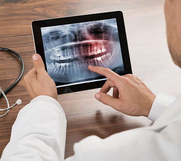 Redwood City Types of Dental Root Fractures